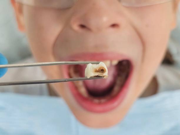 Best Emergency Broken Tooth Repair in Austin, TX